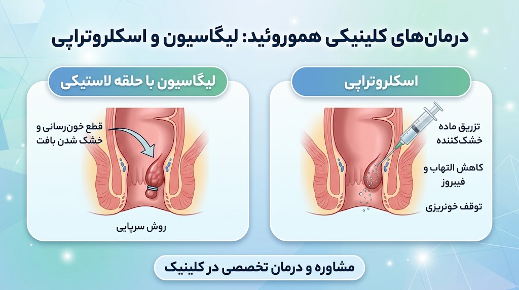 درمان هموروئید بدون جراحی؛ لیگاسیون و اسکلروتراپی