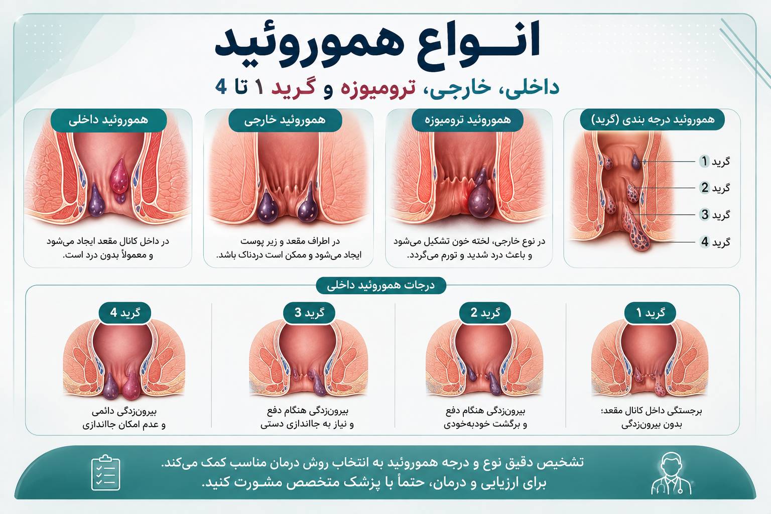 انواع هموروئید؛ داخلی، خارجی، ترومبوزه و گرید ۱ تا ۴